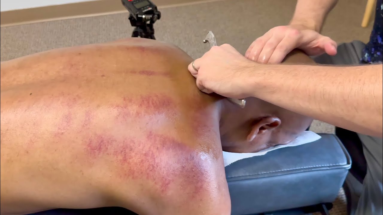 DEEP BACK KNOTS GET SMASHED LIKE PANCAKES | MEGA RED BACK FROM DEEP SCRAPING ASMR