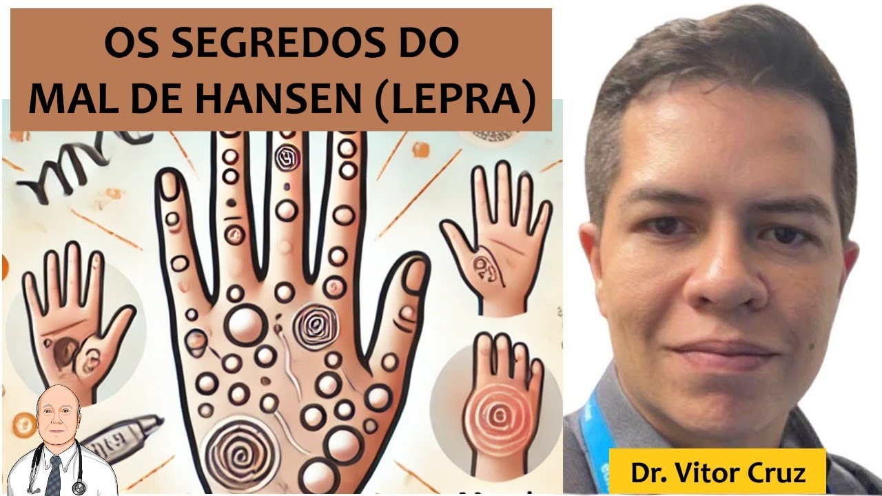 Tudo sobre os sintomas e o tratamento do mal de Hansen (lepra)