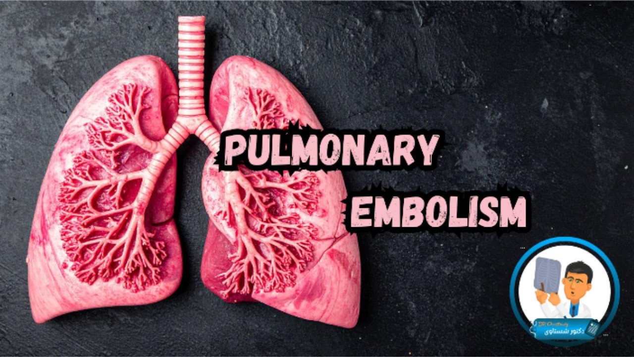 Pulmonary Embolism