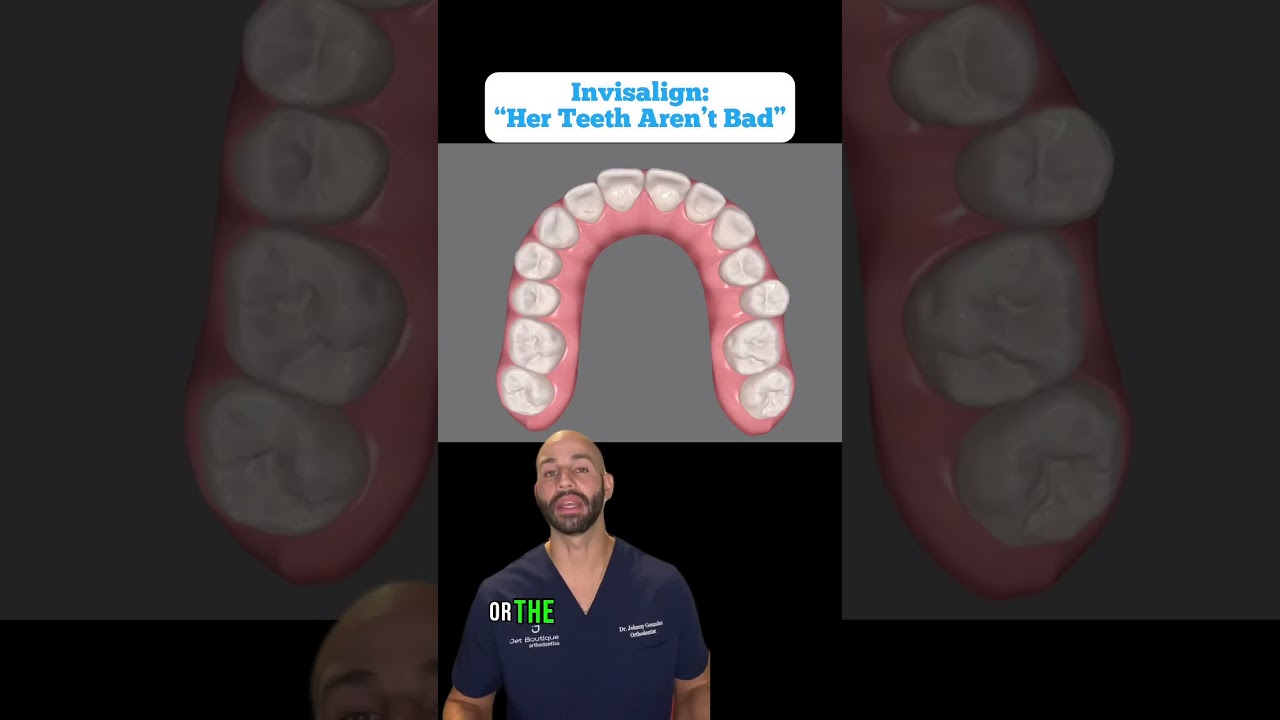 Invisalign Smile Design Timelapse: Before and After (2023)