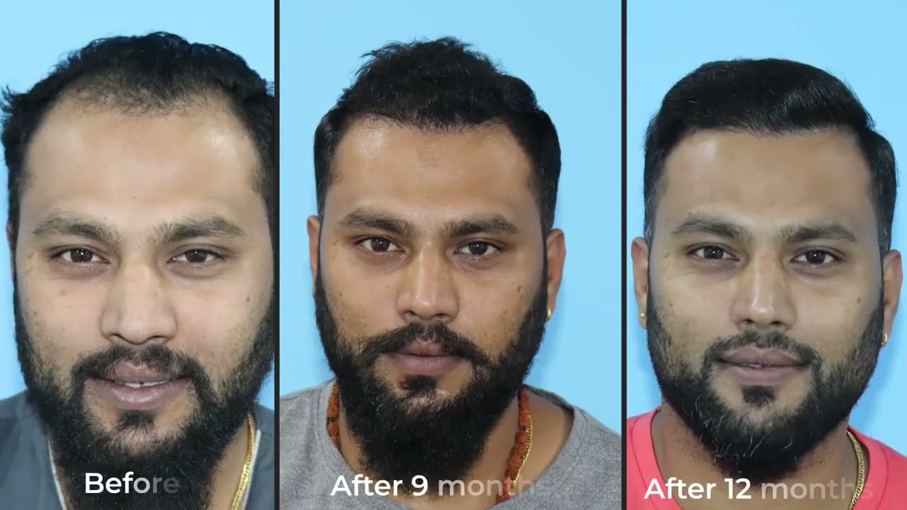 Transformational Results of Mr. Sagar with Direct Hair Transplant at Folliderm, Nepal.