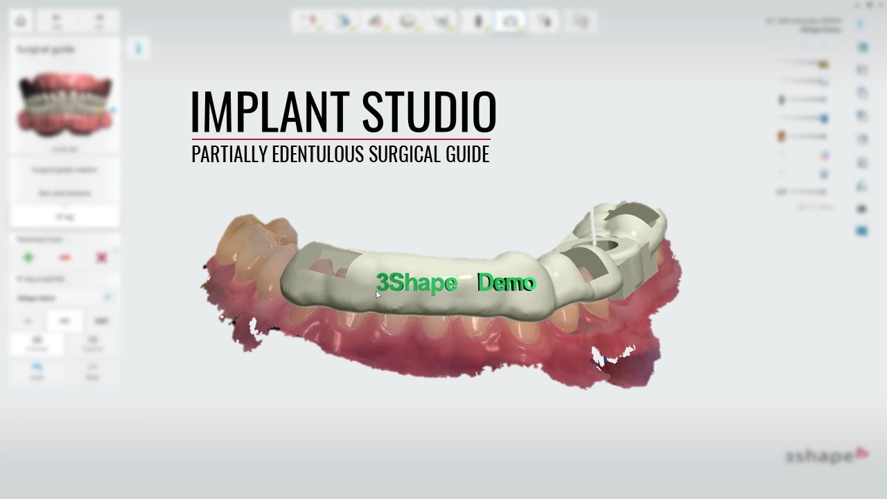 3shape Implant Studio Partially Edentulous
