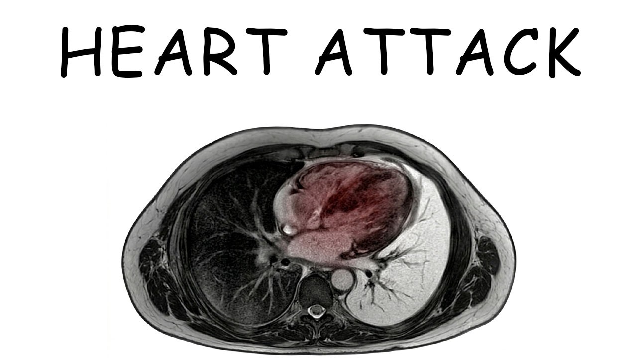 What Dying From a Heart Attack Feels Like