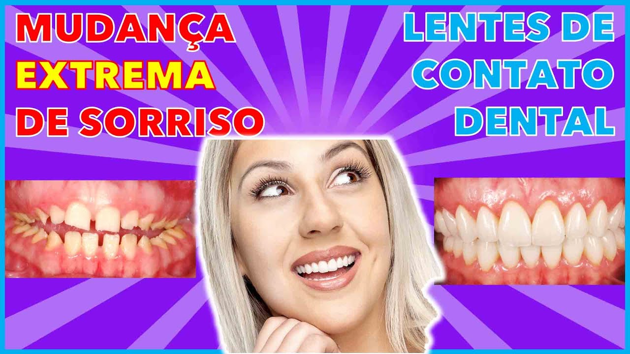 MUDANÇA DE SORRISO EXTREMA COM LENTE DE CONTATO DENTAL E FACETAS DE PORCELANA Dental Esthetic Center