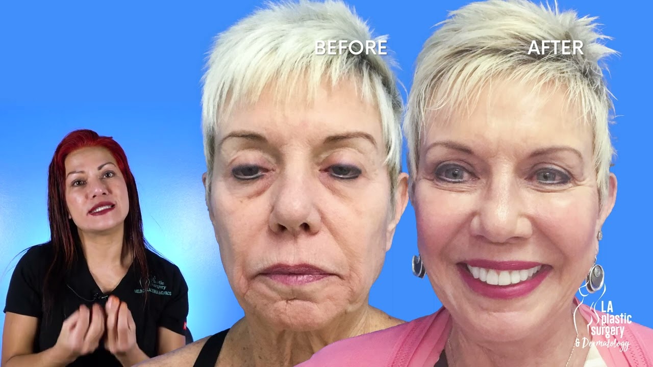 Renuvion Plasma Laser Before and After - PLASMA LYFT FACELIFT By Dr. Lacerna