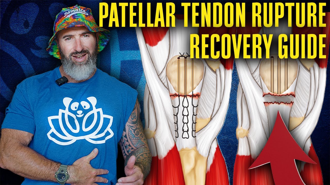 Patellar Tendon Rupture Recovery: 3 Crucial Tips from the World's Leading Expert