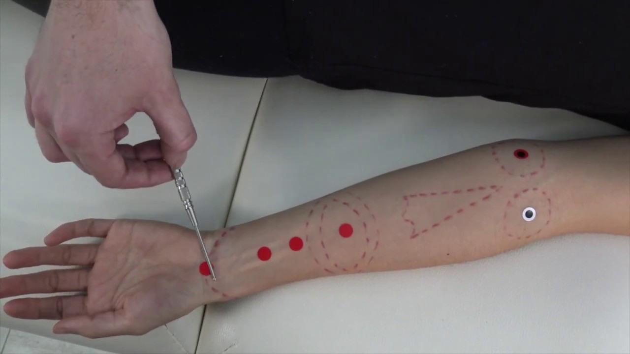 Acupuntura Distal para desarreglos en la cara