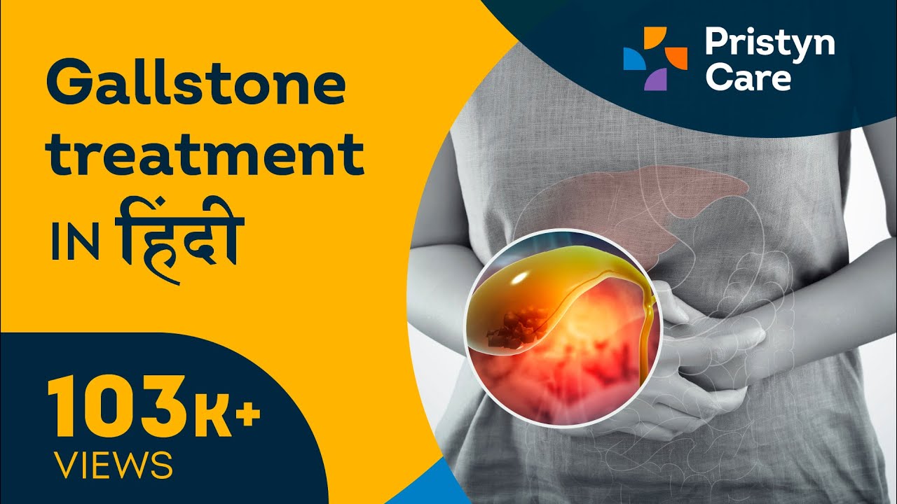 Gall Stone symptoms | Gallstone Treatment in Hindi | For Free Consultation Call Now - 08065105263