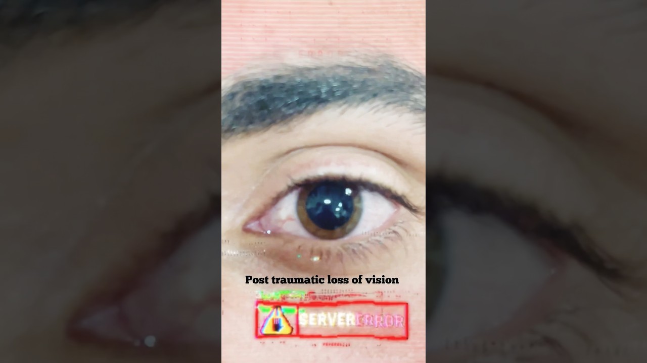 anisocoria , unequal pupil size