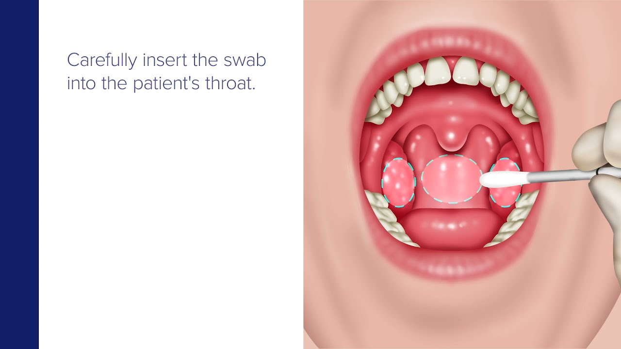 SARS-CoV-2 Clinician Collected Throat Specimen Collection Guide