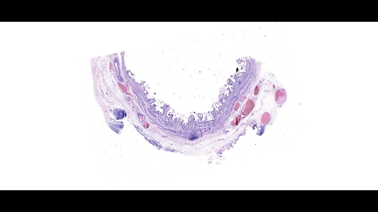 Parasitic Infection - CLONORCHIASIS GALL BLADDER - QUIZ CASE 3 - DIGIPATH TUTORIALS