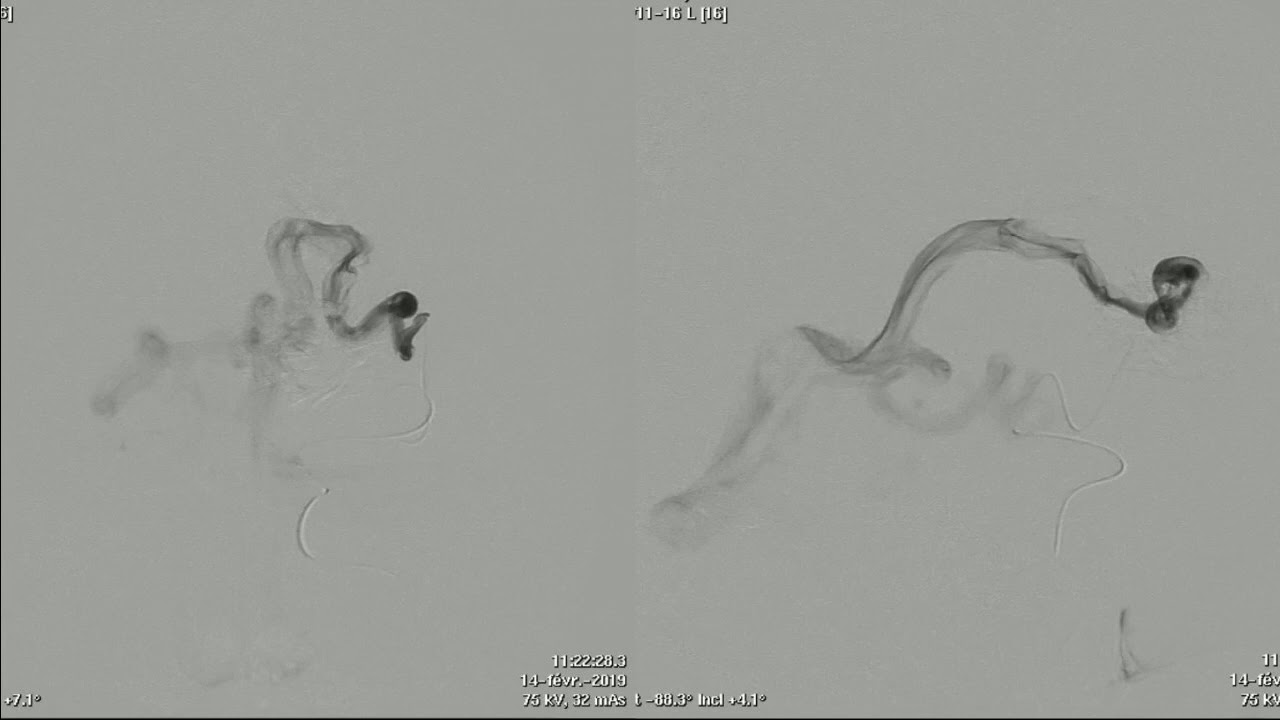 SVIN 2019: Endovascular Embolization of High Spetzler Martin Grade AVMs
