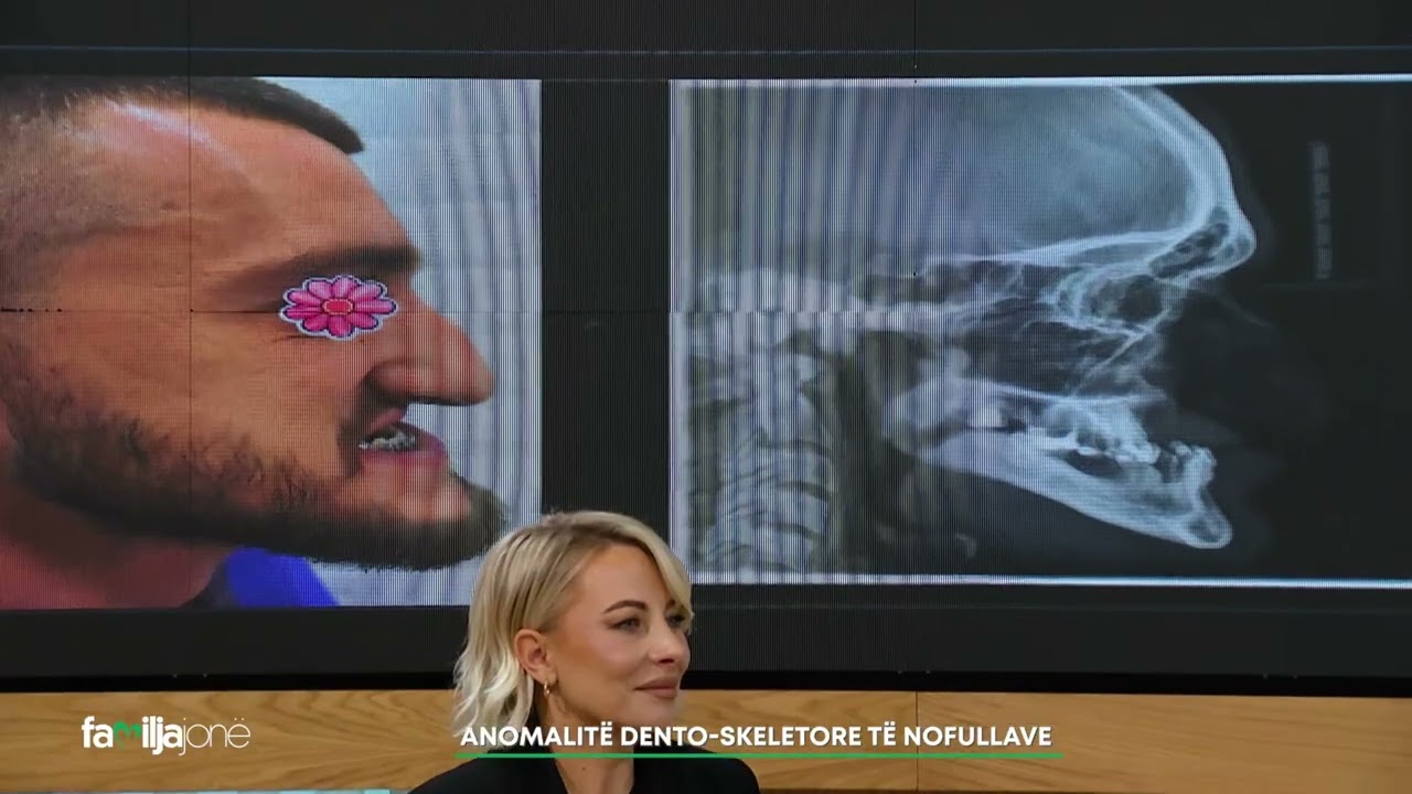 &Ccedil;far&euml; jan&euml;  anomalit&euml; dento-skeletore t&euml; nofullave - flet Dr. Agron Bytyqi, kirurg maksilofacial