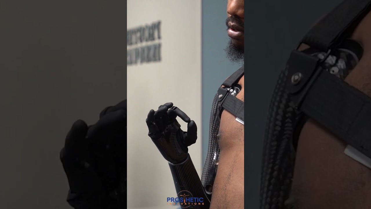 New Trans-humeral Myo-Electric Prosthesis | Prosthetic Innovations