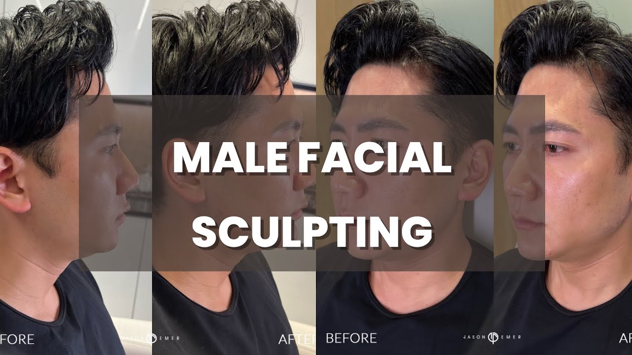 MALE ASIAN FACIAL SCULPTING: JAWLINE AND CHIN CONTOURING FOR A MORE MASCULINE LOOK  | DR JASON EMER