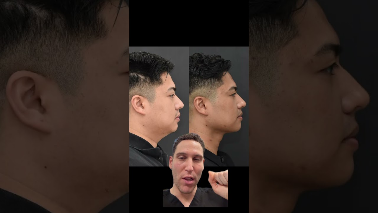 The Ultimate Duo: Chin Lipo and Buccal Fat Removal