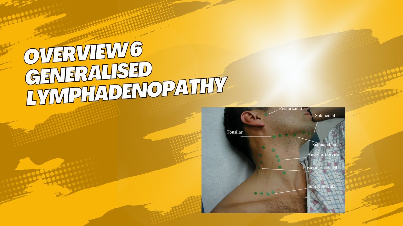 Overview 6 : Generalised Lymphadenopathy
