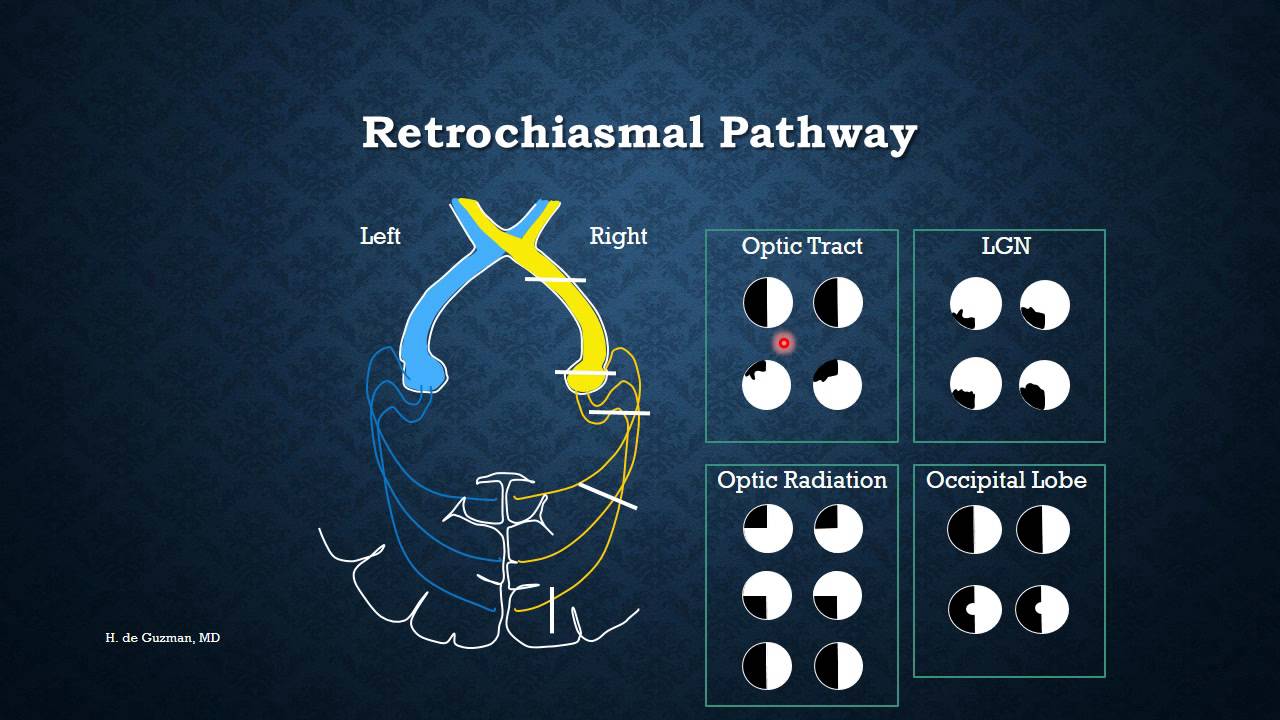Visual Field: The Basics by Dr. Hannah de Guzman