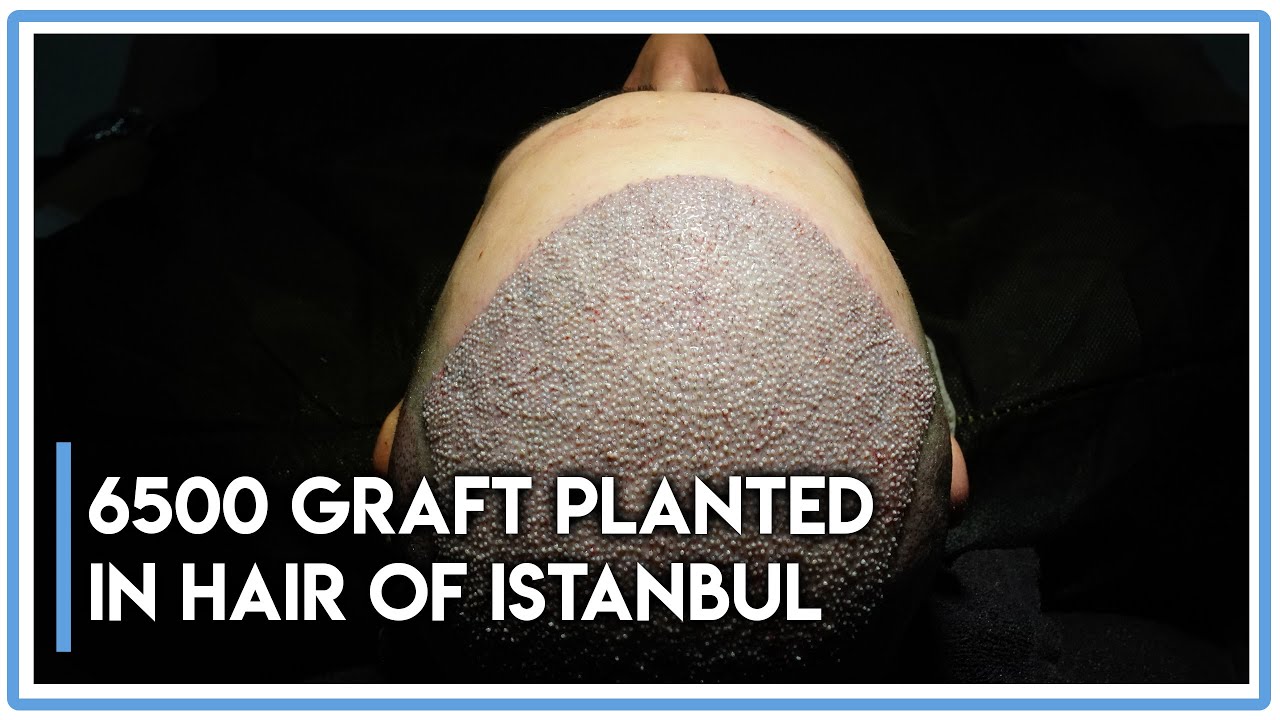 6500 graft planted in Hair of Istanbul #hairtransplant #turkey #hairofistanbul