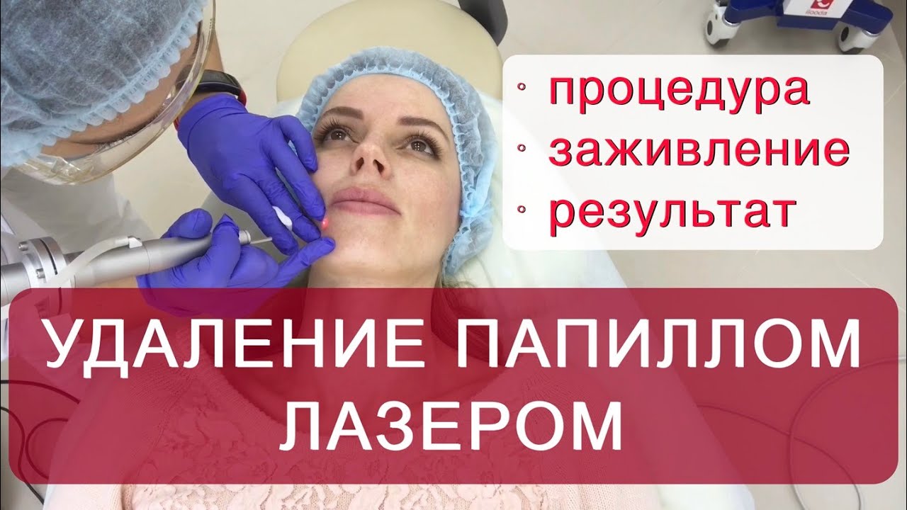 Удаление лазером папиллом  и рубца на лице. Процесс удаления, заживление и результат через 3 недели