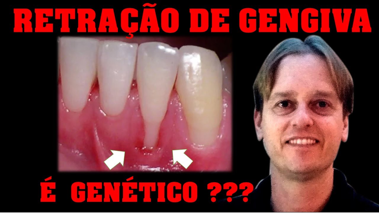 Retra&ccedil;&atilde;o de Gengiva &eacute; 