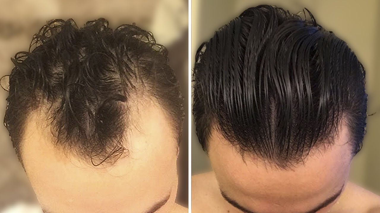 Su Pelo Vuelve De La Tumba En 6 Meses