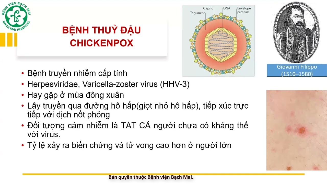 16.Thủy đậu biến chứng ở người lớn - những điều cần biết