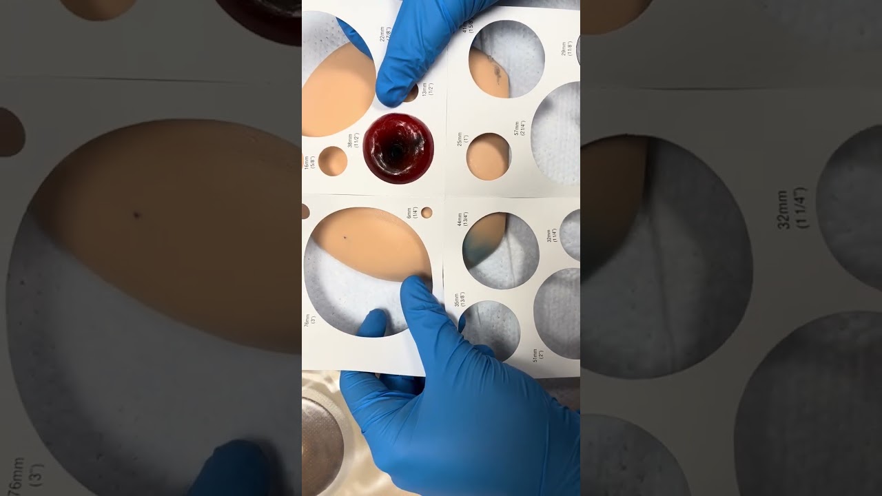 Standard Ostomy Pouch Change with Vent