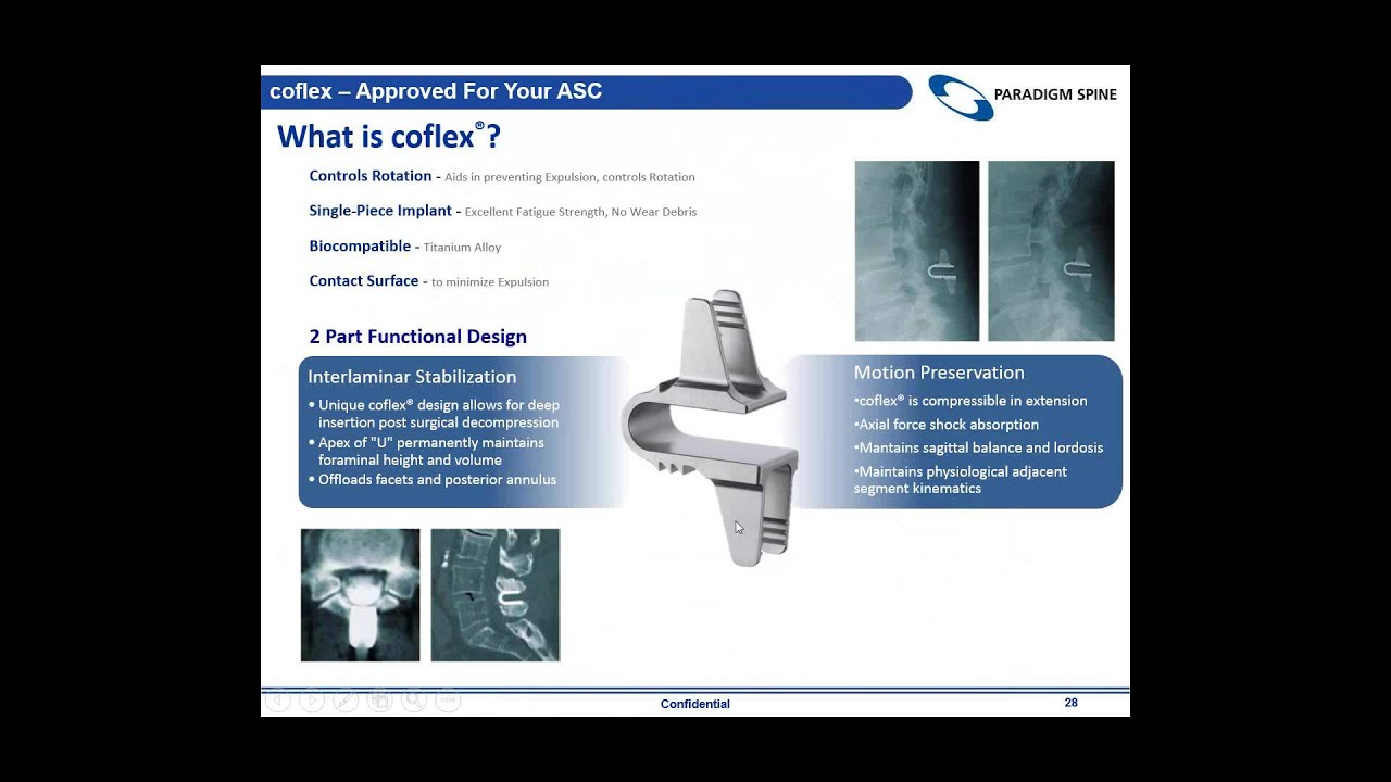coflex NewMIS Non Fusion Solution Spinal Stenosis