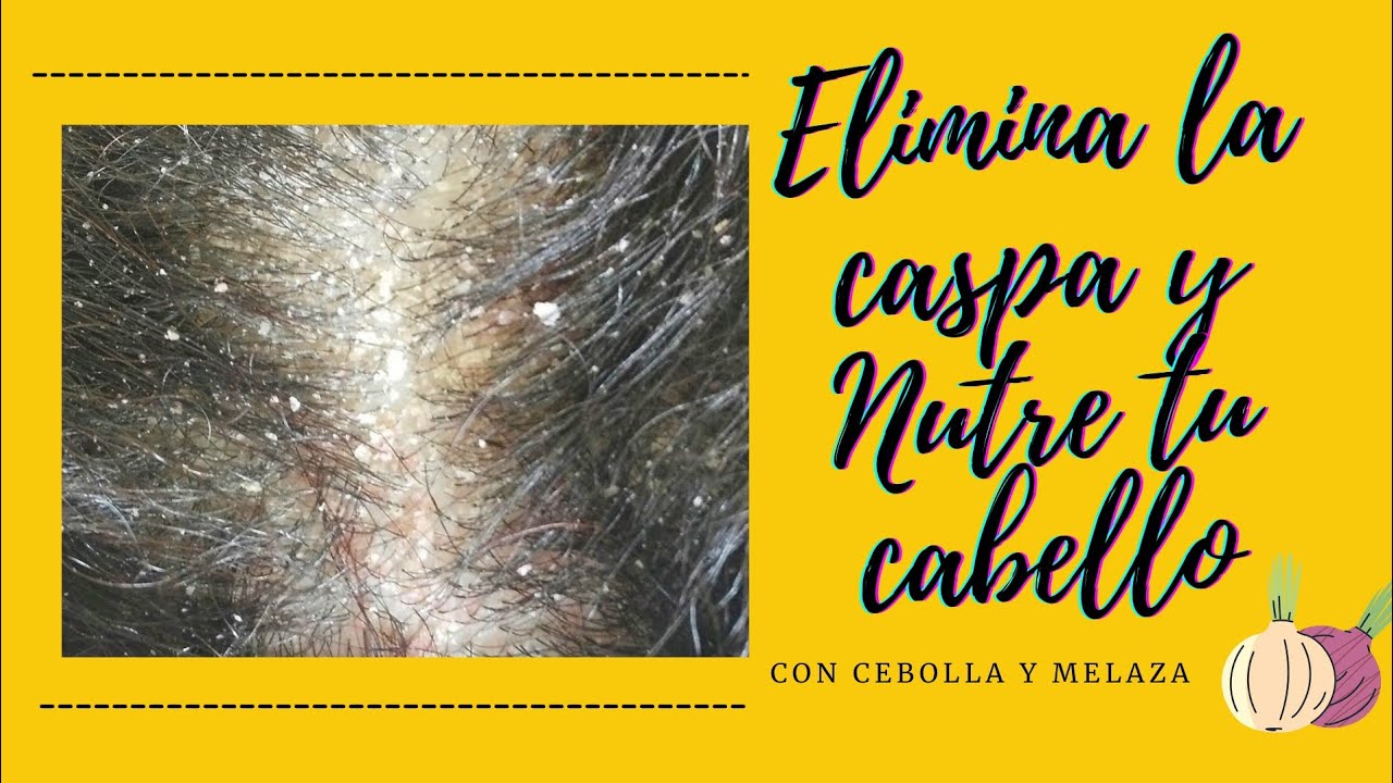Elimina la |CASPA Y SEBORREA| con la CEBOLLA Y MELAZA