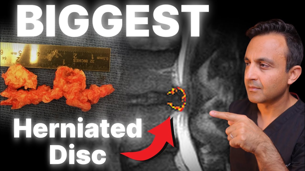 The biggest herniated disc I have ever seen: How I fixed it