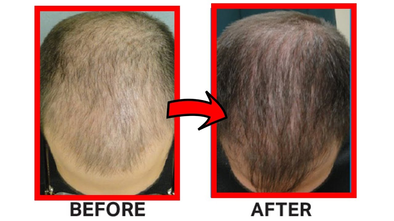 Will PRP Treatment Help you Regrow Hair? PRP Cost and Effectiveness!
