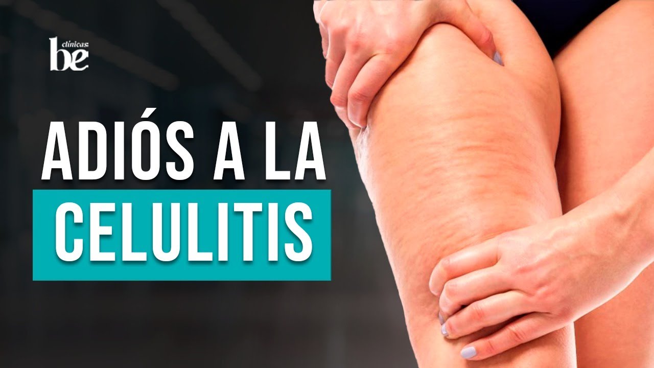 ¡Adiós a la celulitis y la grasa localizada!  Descubre las Ondas de Choque de Storz Medical ✌🏻