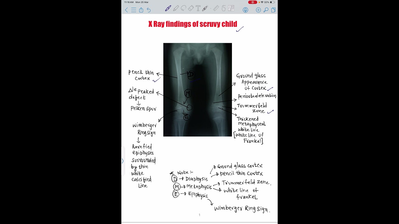 SCURVY//X-RAY//VITAMIN C DEFICIENCY//PAEDIATRICS//RADIOLOGY
