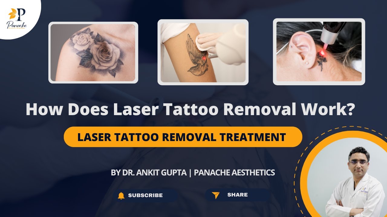 Laser Tattoo Removal | How to Get Rid of Tattoo | Tattoo Removal Explained | Q Switch vs PICO
