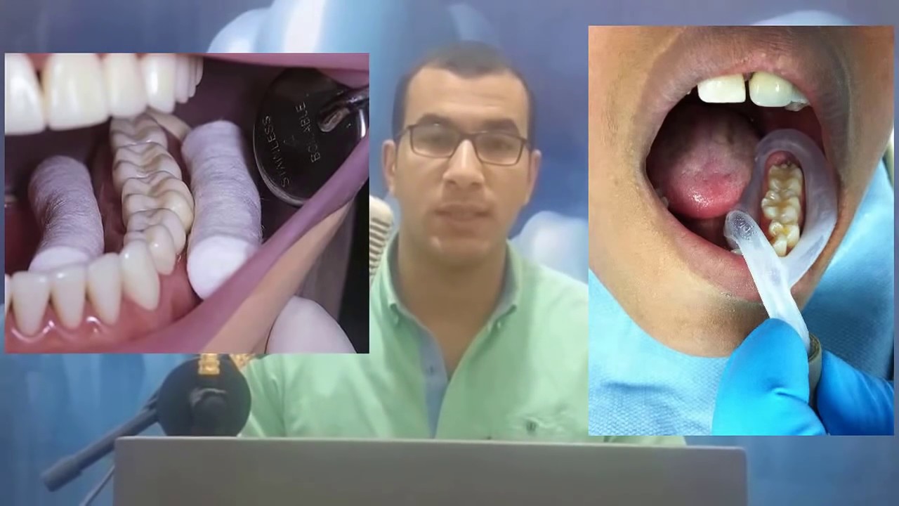 Apexogenesis in Permanent Teeth
