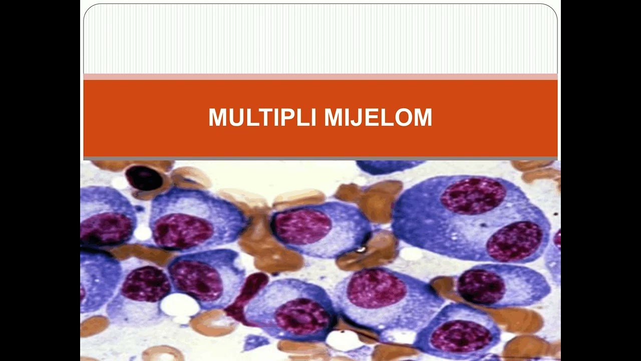 7  Hronična limfocitna leukemija i multipli mijelom Prof dr Jelena Bila   NEOPLAZIJE ZRELIH B LIMFOC