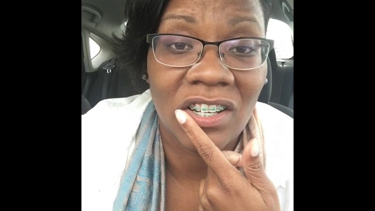 Adult Braces: No More Drama, Fillings, New Wires
