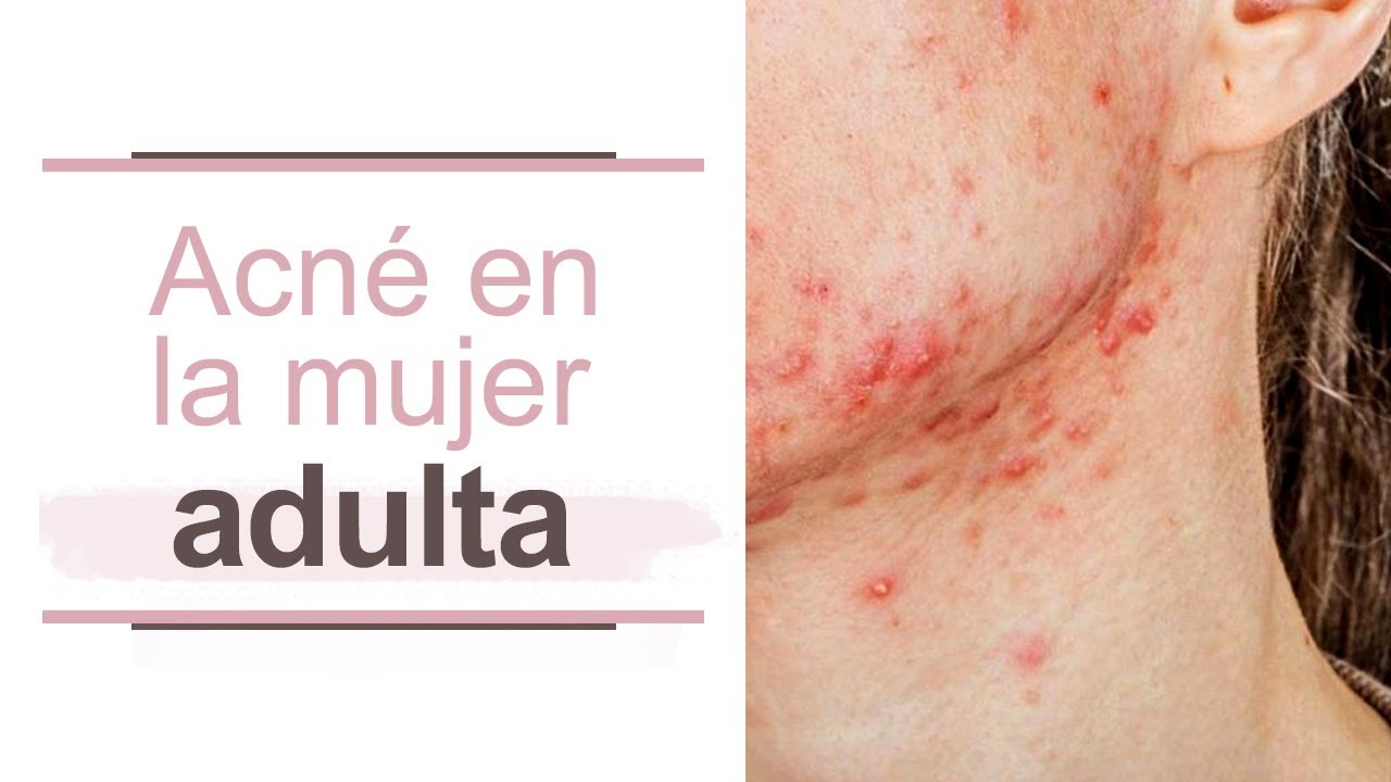 Acné en la mujer adulta l Dra. María Clara Mejía