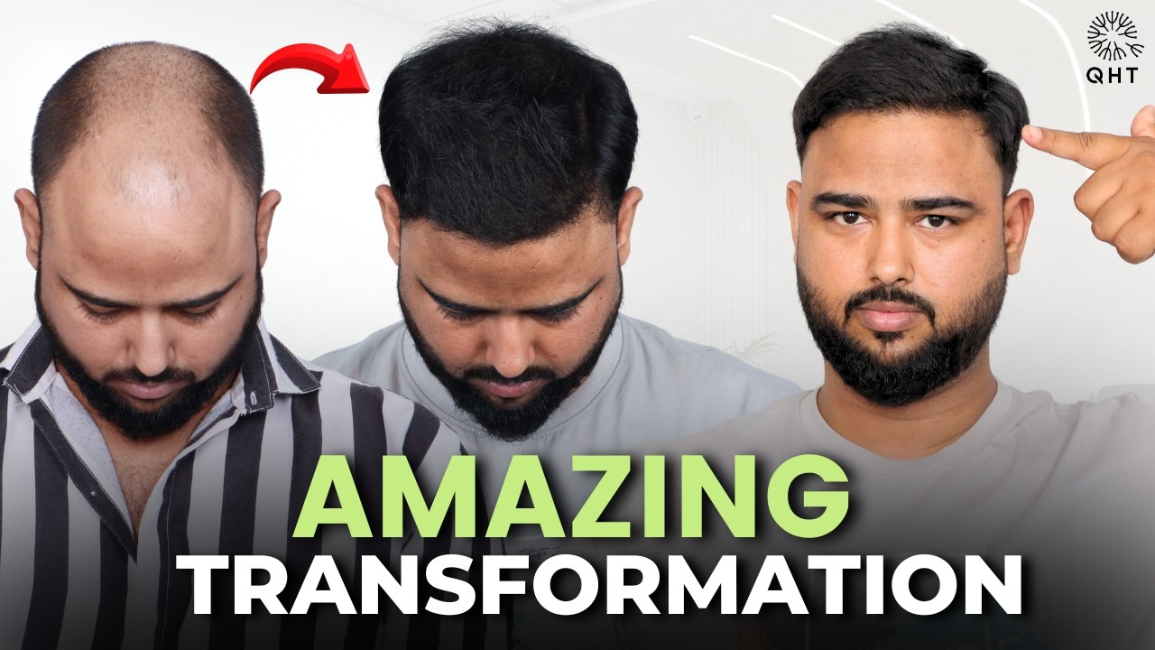 Grade 6 Hairloss | Hair Transplant Results | Grade 6 Hair Transplant Result | QHT | Grade 6 Baldness