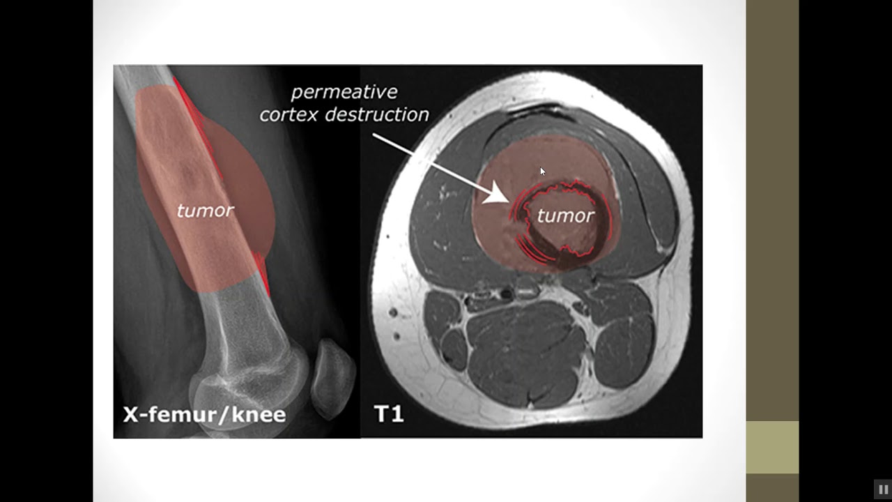 MRI Physics of STIR and FLAIR Sequences Part 19 in Arabic