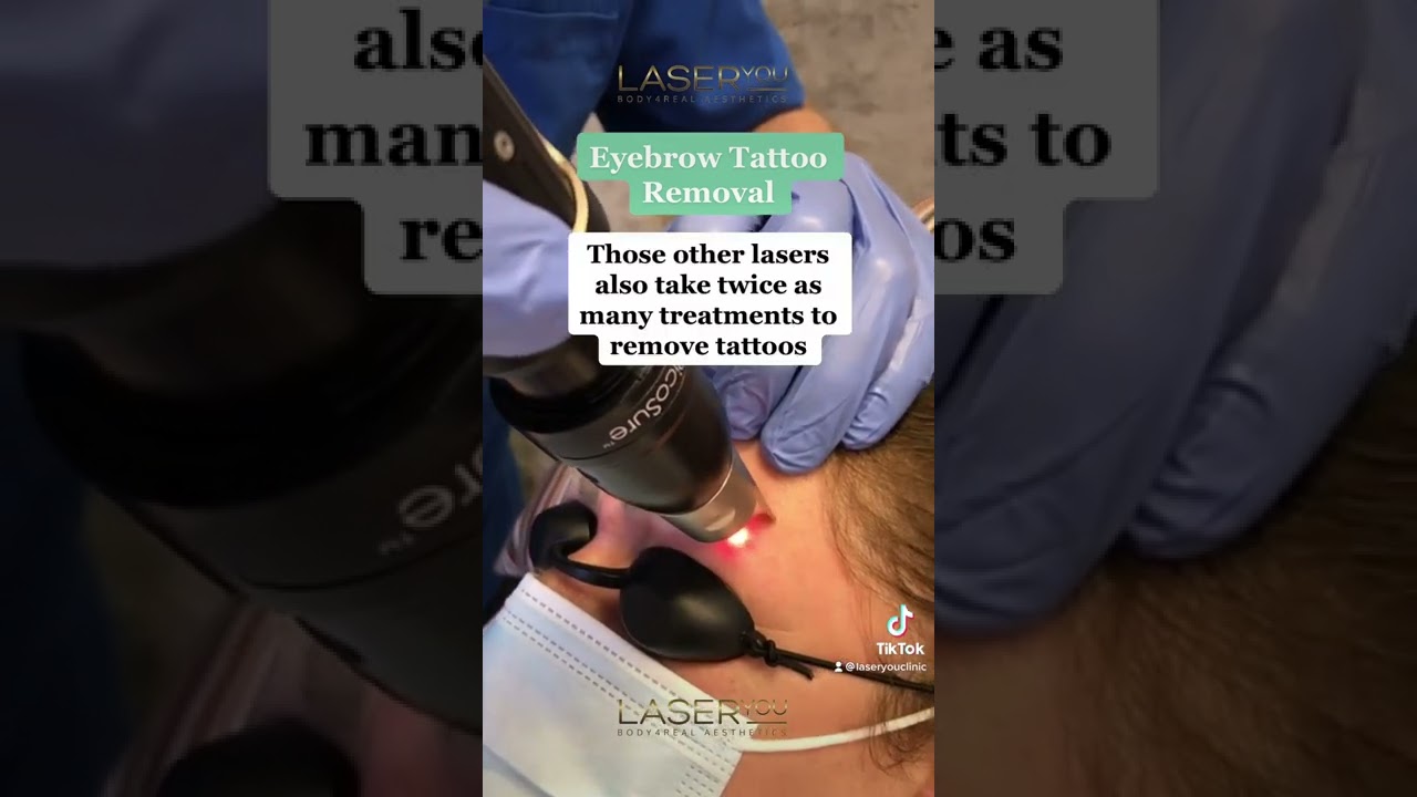 Eyebrow Tattoo Removal