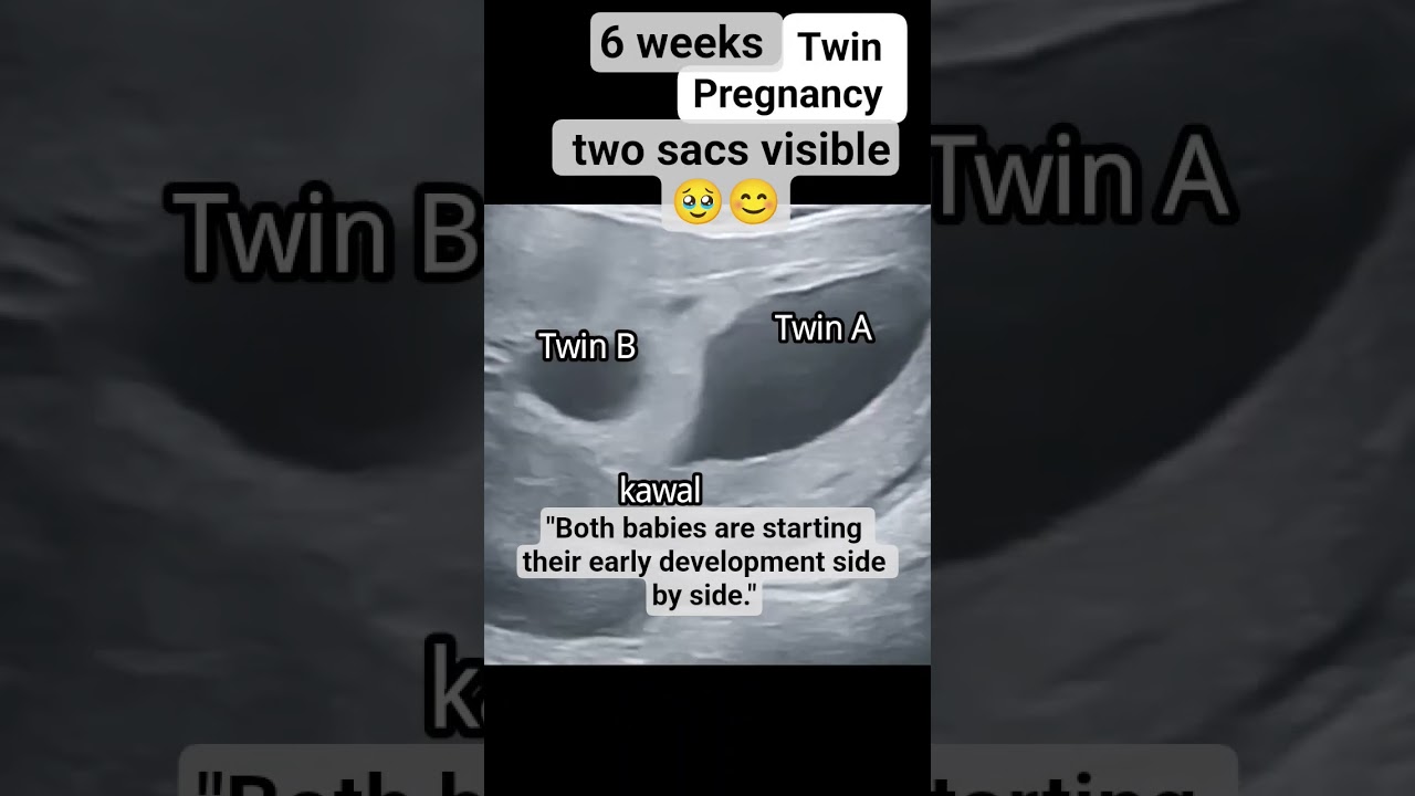 👶👶 Twins Pregnancy at 6 Weeks | Early Signs & Ultrasound #ultrasound #baby