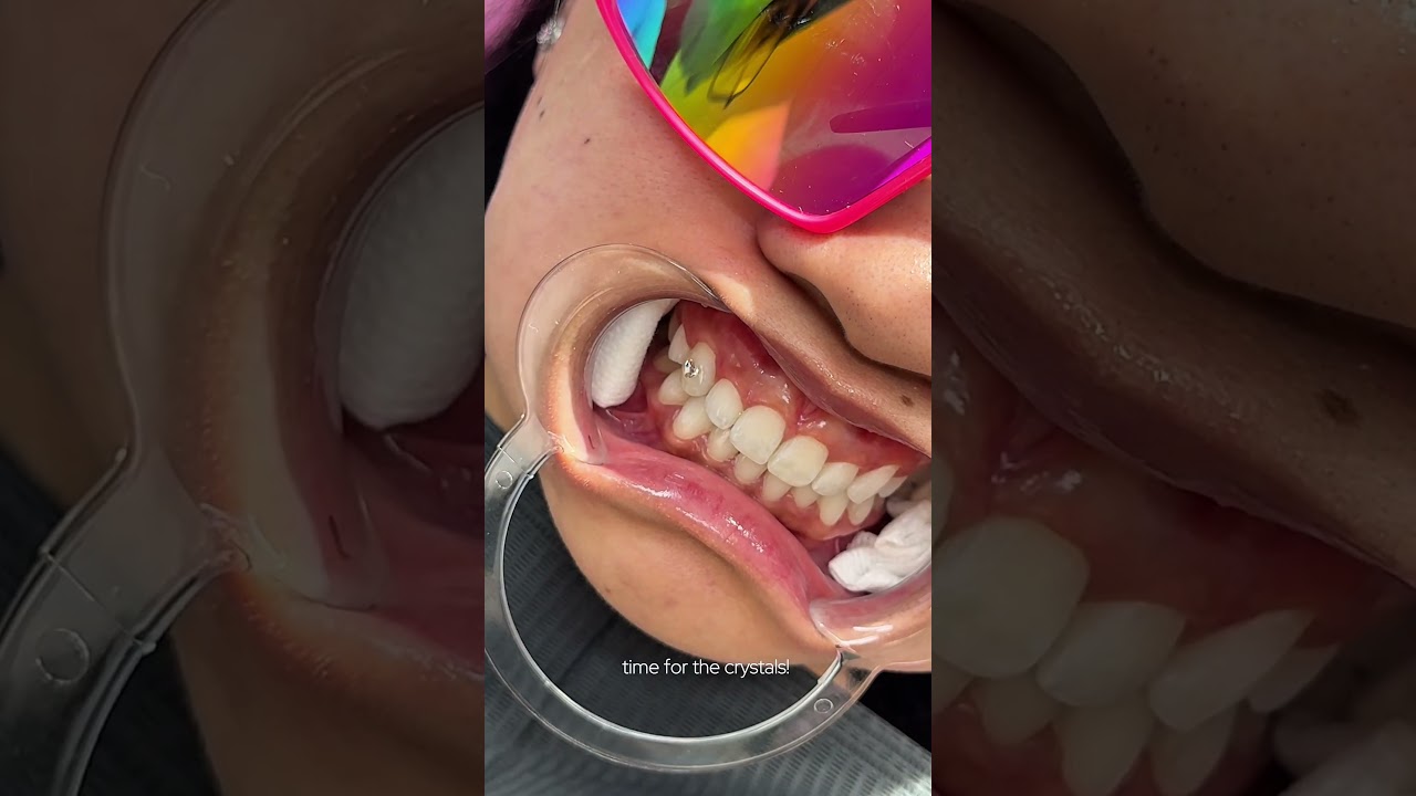 tooth gem transformation 💎 