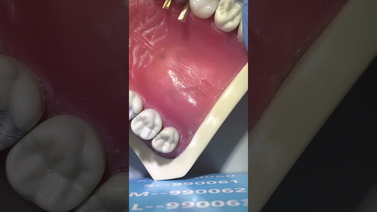 Composite restoration on 25, part 4