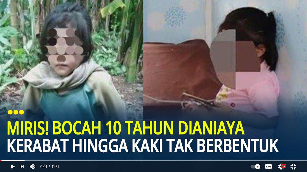 Nelangsa Bocah 10 Tahun di Nias Dianiaya Kerabat Bertahun-tahun Hingga Kaki Tak Berbentuk