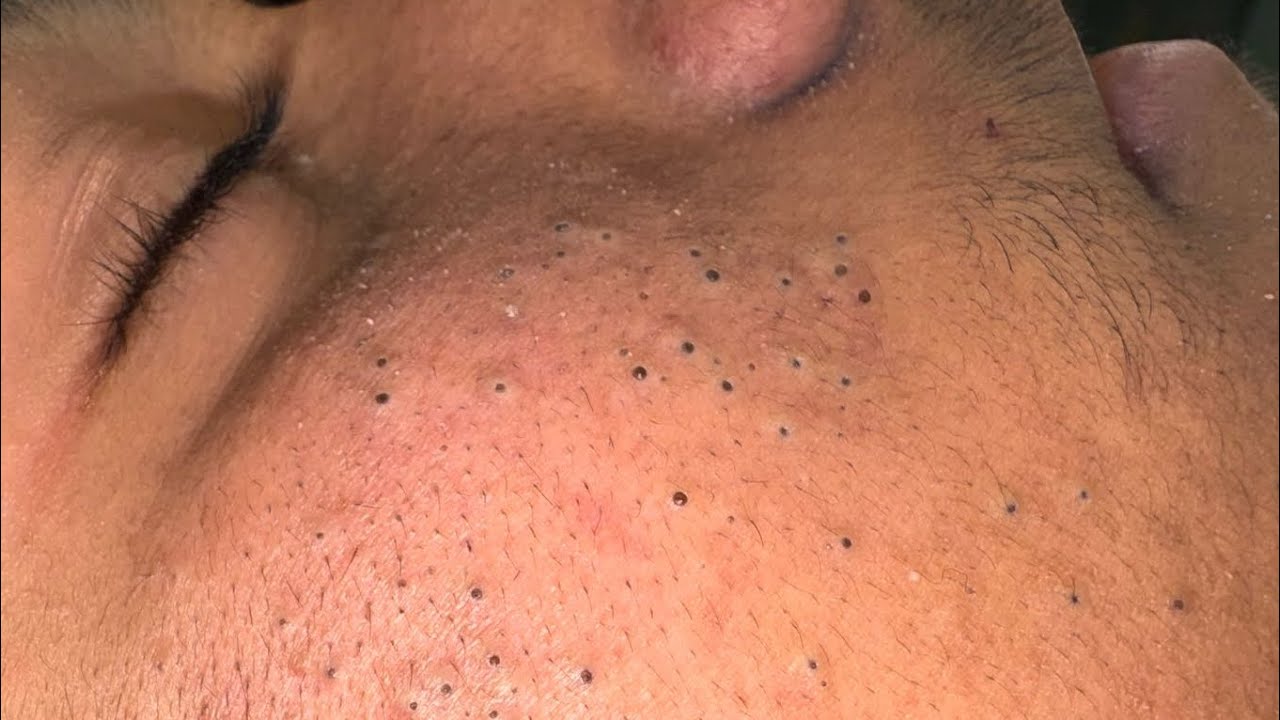SATISFYING Blackhead Removal & Pimple Popping | Best Acne Treatment and Solutions