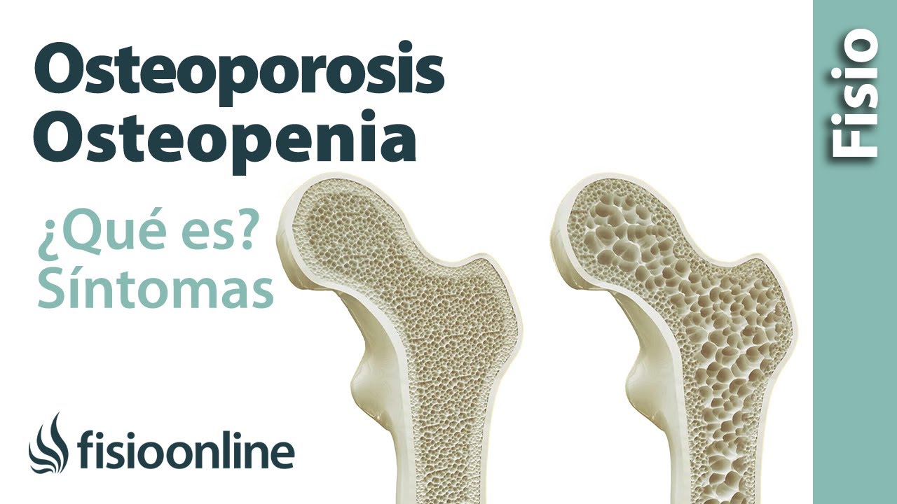 Osteoporosis y osteopenia - Qué es, causas, síntomas y tratamiento