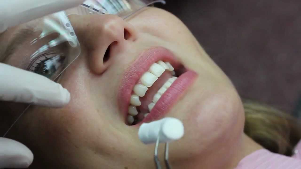 Invisalign Video Blog, Bonding Attachments [HD] - Sierra 05