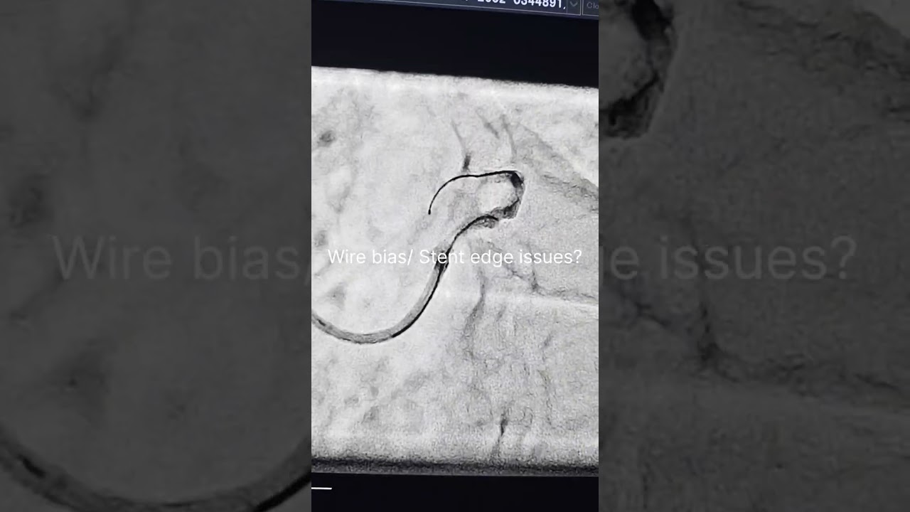 Case 36: Surgically Equivalent Revasc   in diffuse complex 3VD with normal EF